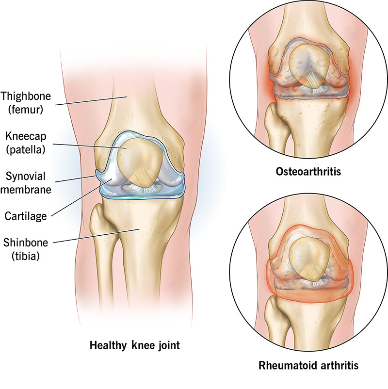 Knee Arthritis